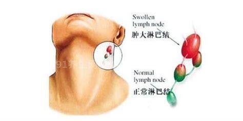 长期发热可能是淋巴癌，应做9项检查