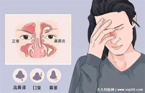 为什么医院不推荐用鼻炎膏