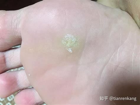 鸡眼是长什么样的图片