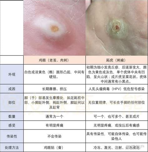 鸡眼和寻常疣的区别图