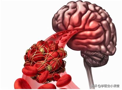 脑供血不足每天抓手100下促进血液循环，耸肩动作也有效(文字)