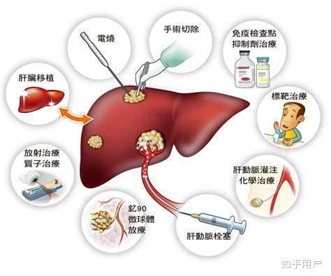 晚期肝癌夜里睡觉三大预兆，警惕口干舌燥/右上腹刺疼是肝脏不好了