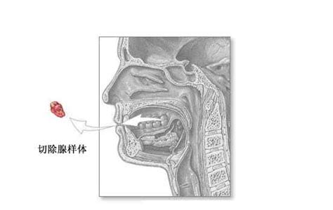 切除腺样体后悔莫及到家，一旦摘除无