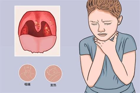 新冠咽喉肿痛与普通咽喉肿痛区别是