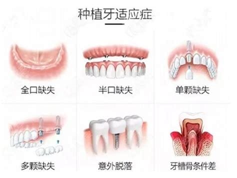 种植牙齿多少钱一个2022，含国产/韩国/美国/瑞士（价格表一览表）