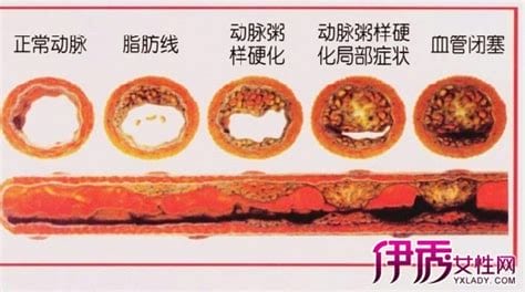 动脉硬化症状是什么