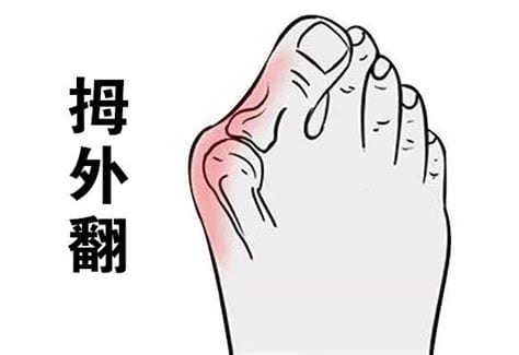 大脚骨如何治疗