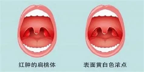 扁桃体发炎一直咳嗽怎么办