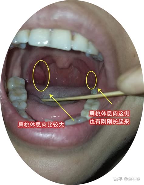 扁桃体结石什么症状