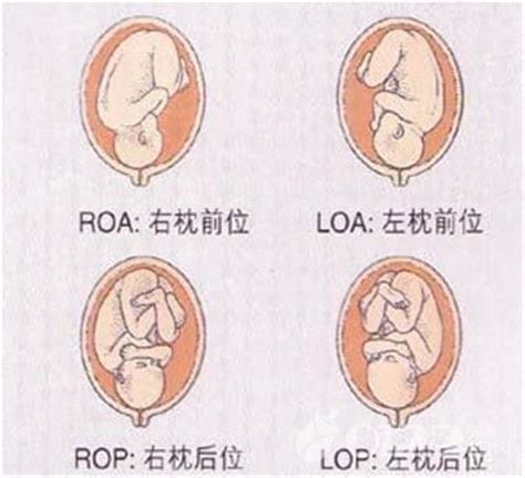 胎位loa什么意思