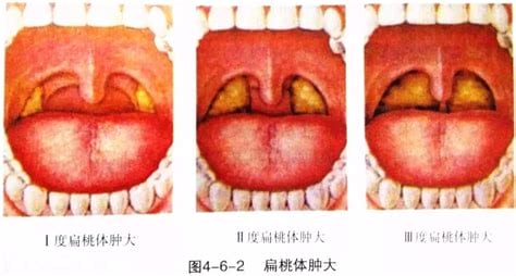 扁桃体二度肿大严重吗