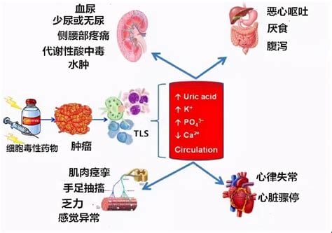 肿瘤溶解综合征症状