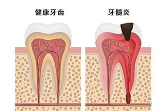 牙髓炎怎样快速止痛