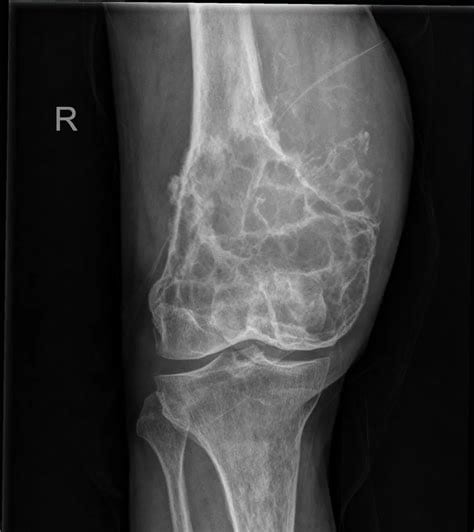 骨巨细胞瘤的x线表现