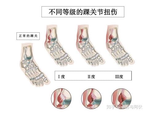 脚崴了一般多久能好