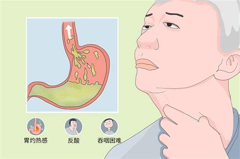 食管炎的症状和治疗法