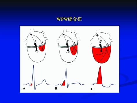 预激综合征是什么病