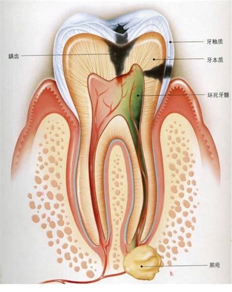 牙髓炎应该怎么办