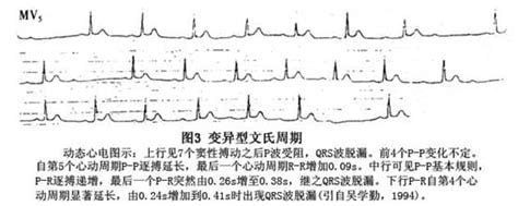 什么是i度房室传导阻滞