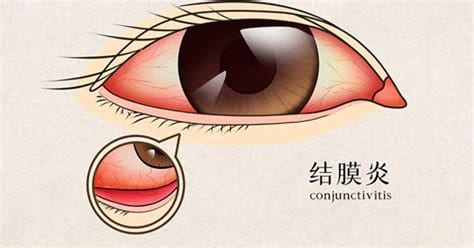 结膜炎是怎么引起的