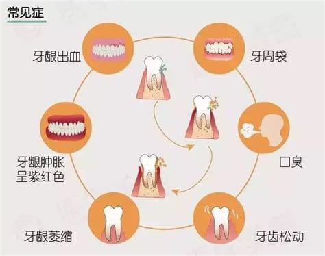 治疗牙周炎的方法有哪些