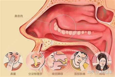 鼻息肉指的是什么