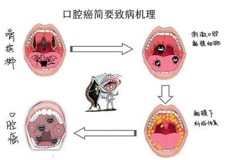 嚼槟榔的危害