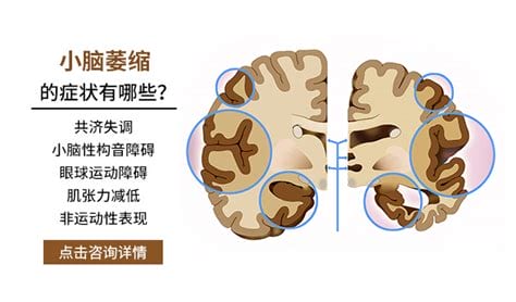 小脑萎缩症状是什么