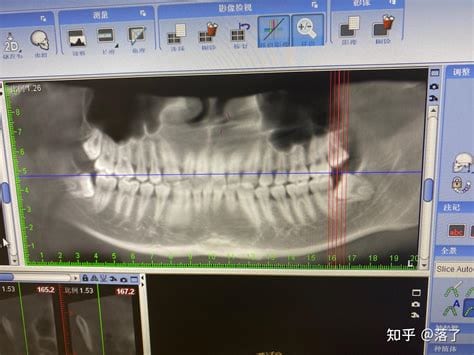 智齿发炎一定要拔吗