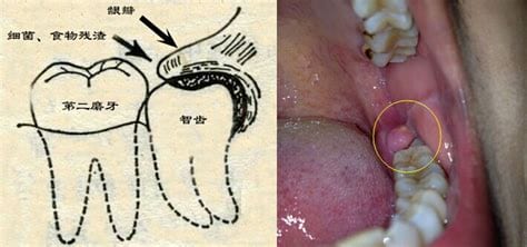 智齿冠周炎脓肿应该怎么办