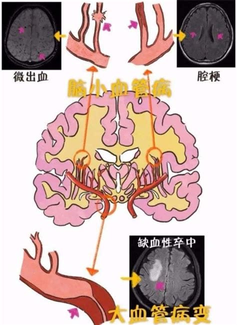 腔隙性脑梗塞能恢复吗