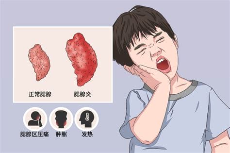 急性腮腺炎容易传染吗