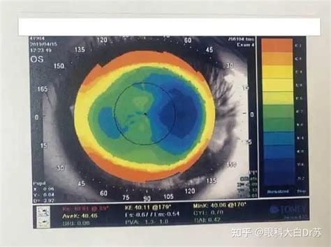 全飞秒手术有什么后遗症