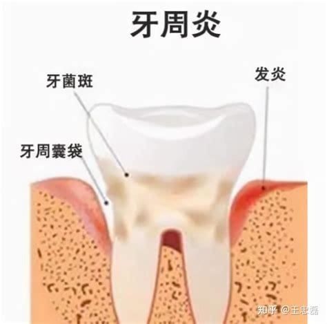 牙缝变大还能恢复吗