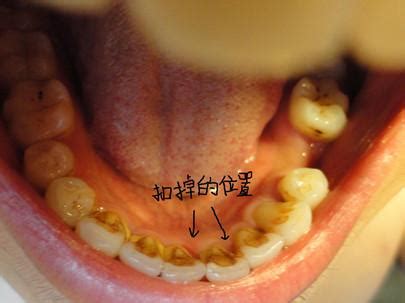 牙齿内侧的黄垢怎么去除