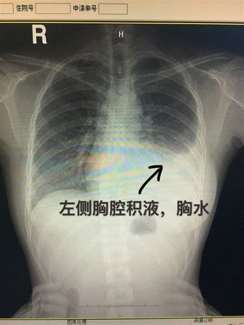 胸腔积液应注意什么