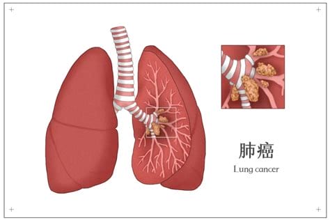 肺部肿瘤临床症状