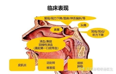 鼻咽癌的早期症状是什么