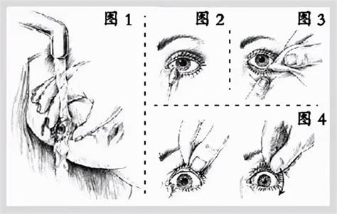 眼睛进入异物的处理方法