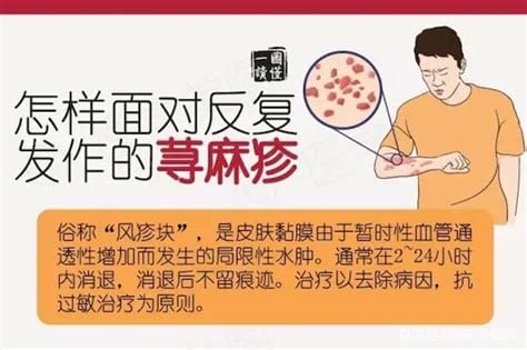 荨麻疹怎么治疗