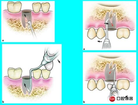 拔牙根的过程