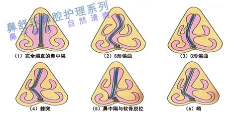 鼻塞是什么原因导致的