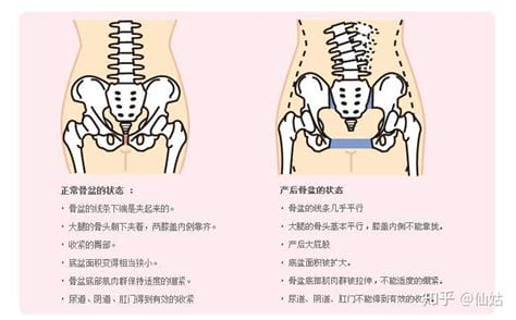 骨盆倾斜怎么矫正