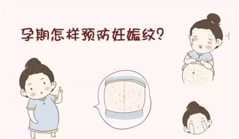 怎样防止妊娠纹