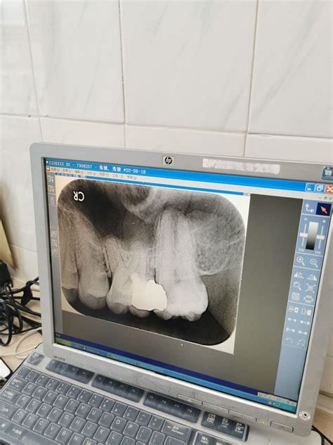 根管治疗到底疼不疼